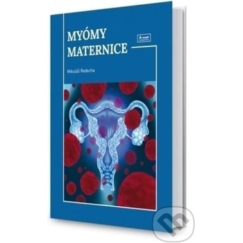 Myómy maternice - Mikuláš Redecha
