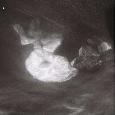 PHOEBE LOU, ALICE - GLOW LP
