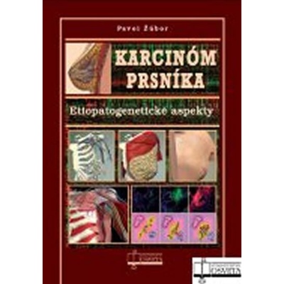 Karcinóm prsníka