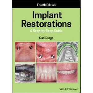 Implant Restorations (ISBN: 9781119538110)