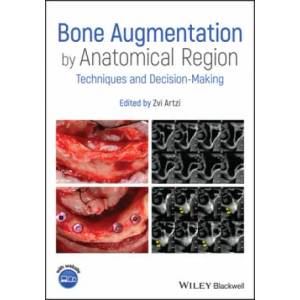 Bone Augmentation by Anatomical Region - Techniques and Decision-Making | Z Artzi (ISBN: 9781119427841)