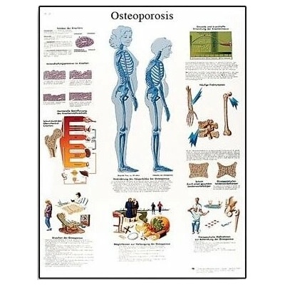 Schéma - osteoporóza - AJ - 50x67 cm Papír bez lišty