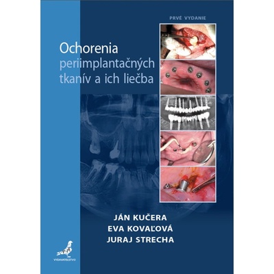 Ochorenia periimplantačných tkanív a ich liečba - Ján Kučera, Eva Kovaľová