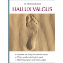 Hallux valgus