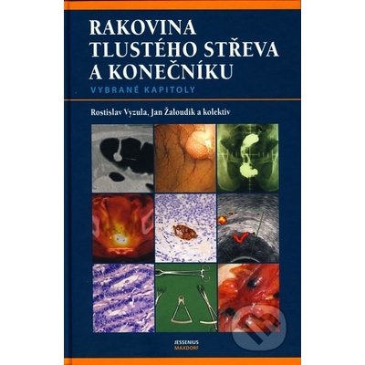 Rakovina tlustého střeva a konečníku - vybrané kapitoly Vyzula Rostislav, Žaloudík Jan a kolektiv