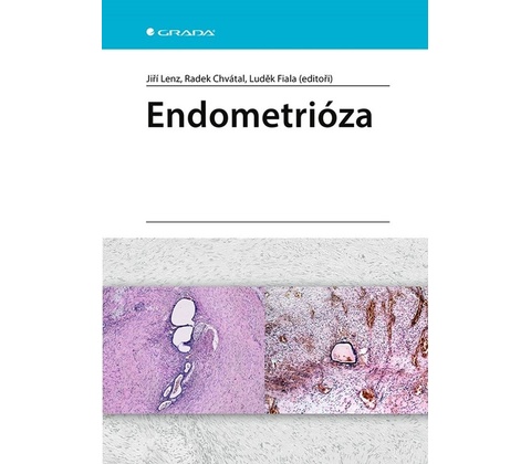 Endometrióza