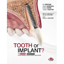 Tooth or Implant? The recovery or replacement of the severely compormised natural tooth