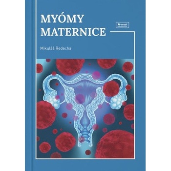 Myómy maternice - Mikuláš Redecha