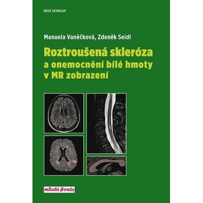 Roztroušená skleróza a onemocnění bílé hmoty v MR zobrazení