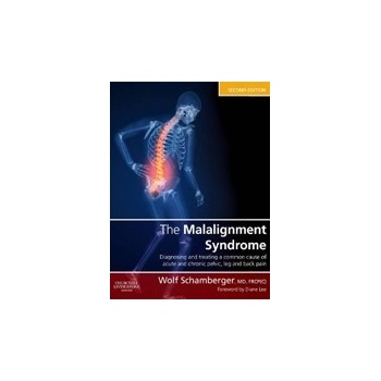 Malalignment Syndrome: Common Pelvic and Back Pain