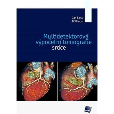 Multidetektorová výpočetní tomografie srdce