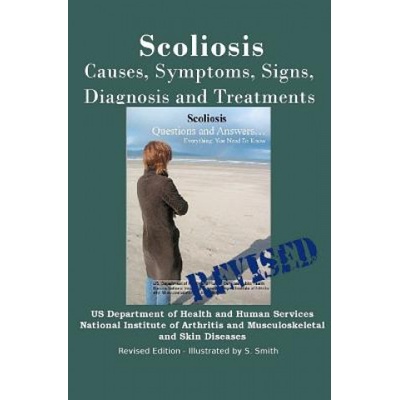 Scoliosis: Revised Edition: Causes, Symptoms, Signs, Diagnosis and Treatments | Institutes of Health National Institute, S Smith, S Smith