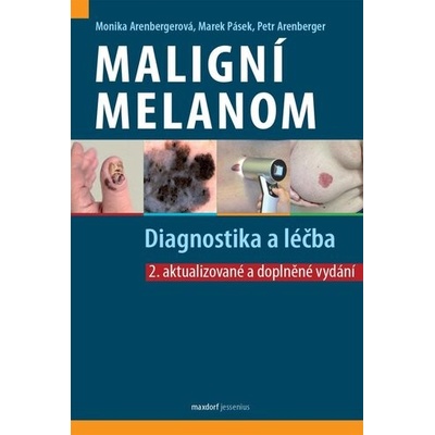 Maligní melanom - Diagnostika a léčba