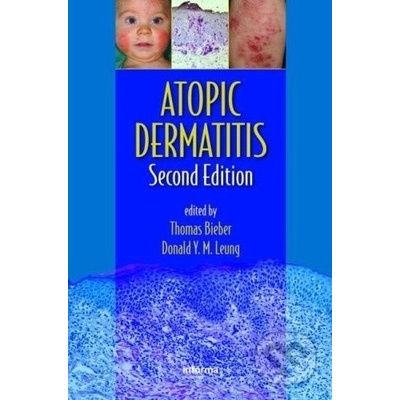 Atopic Dermatitis - Thomas Bieber, Donald Y. M. Leung