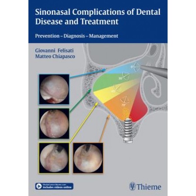 Sinonasal Complications of Dental Disease and Treatment