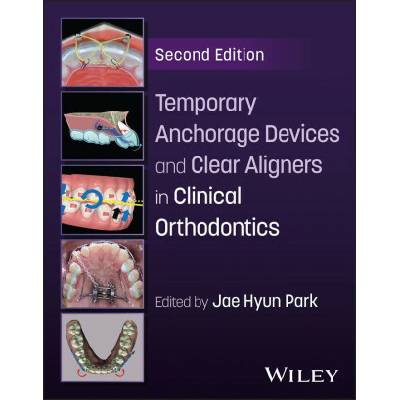 Temporary Anchorage Devices and Clear Aligners in Clinical Orthodontics