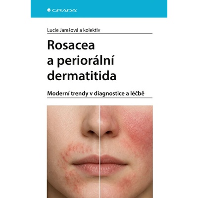 Rosacea a periorální dermatitida Lucie Jarešová